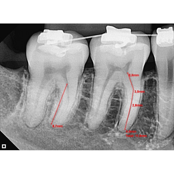 Eagle Digital Sensor – Tamanho 2 - Imagem 2