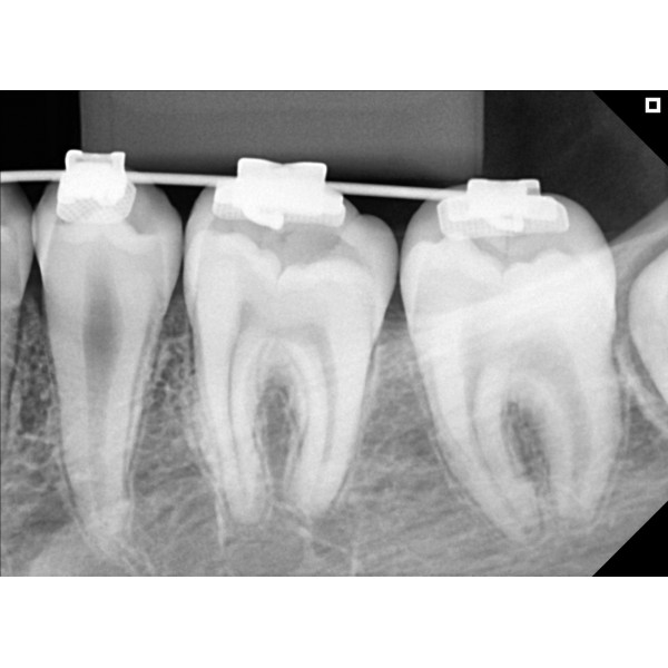 Eagle Digital Sensor – Tamanho 2 - Imagem 3