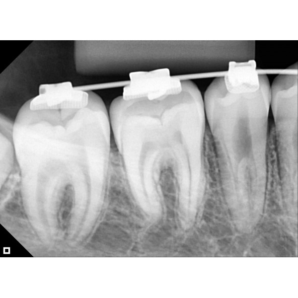 Eagle Digital Sensor – Tamanho 2 - Imagem 4