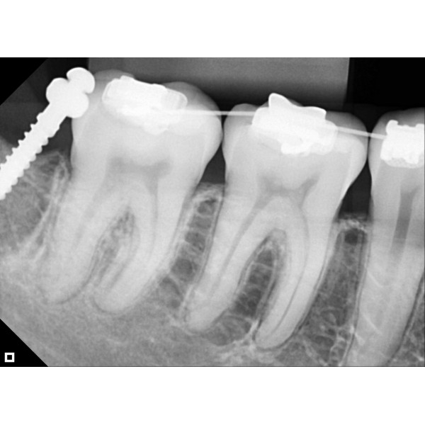 Eagle Digital Sensor – Tamanho 2 - Imagem 5