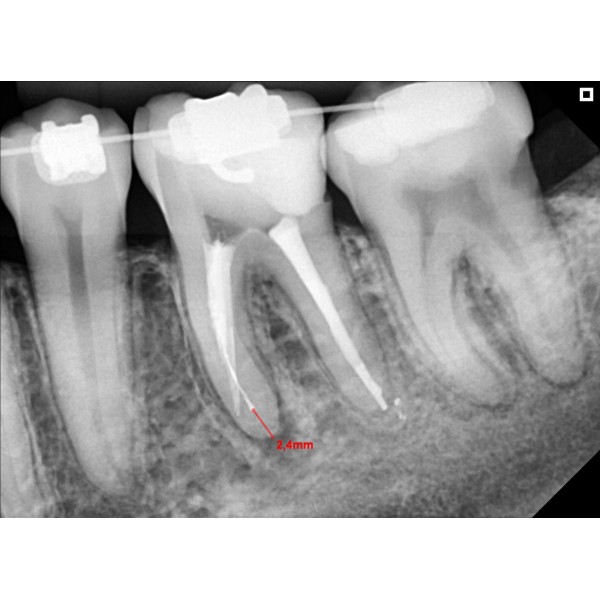 Eagle Digital Sensor – Tamanho 2 - Imagem 6