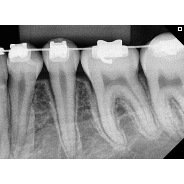 Eagle Digital Sensor – Tamanho 2 - Imagem 7