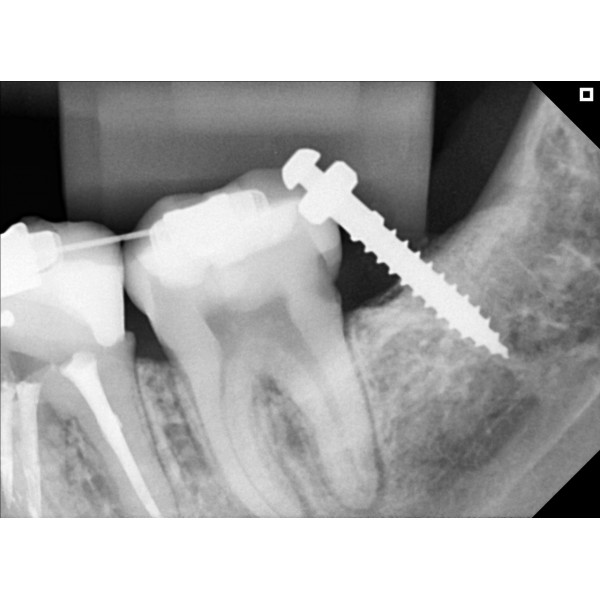 Eagle Digital Sensor – Tamanho 2 - Imagem 8