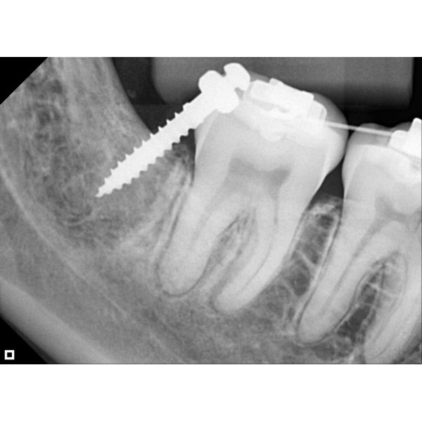 Eagle Digital Sensor – Tamanho 2 - Imagem 9